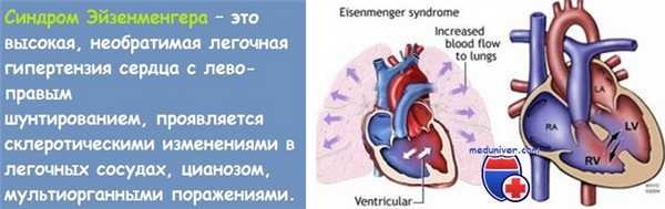 комплекс эйзенменгера