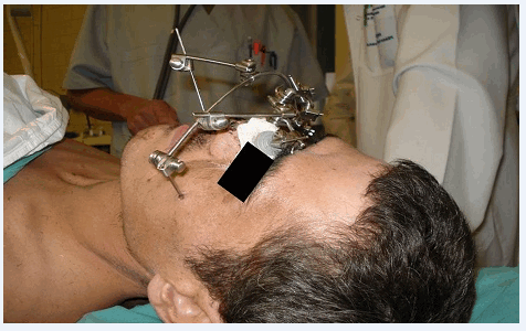 Рис. 1. Внешний вид пострадавшего И. после операции