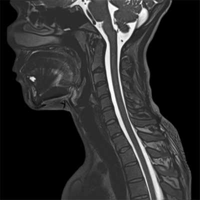 кт шейного отдела