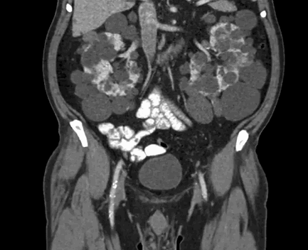 КТ в разных проекциях показывает опухоль в левой почке