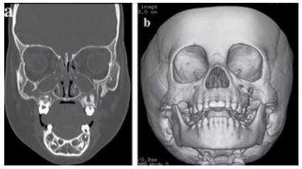 КТ лицевого черепа с 3D-реконструкцией