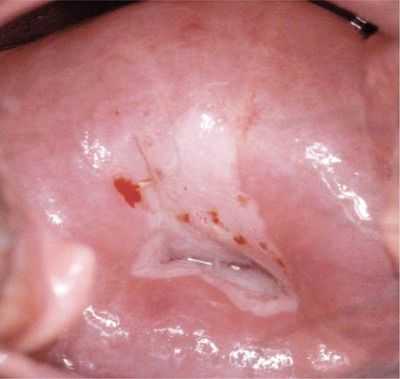 Атипичные клетки