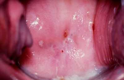 Дисплазия шейки матки