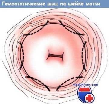 гемостатические швы на шейке матки