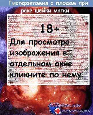 Гистерэктомия при раке шейки матки у беременной