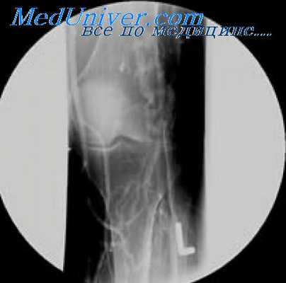 тромбоз артерий