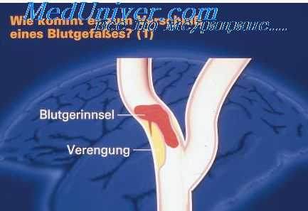 артериальная непроходимость