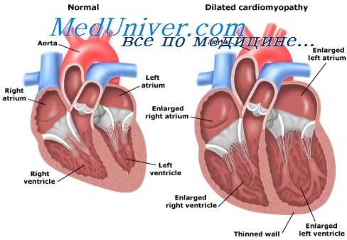 сердечная недостаточность