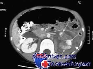 лечение травм почек