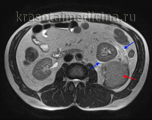 МРТ ОБП. Повреждение левой почки. Забрюшинная гематома (красная стрелка), отек перинефральной клетчатки (синяя стрелка).