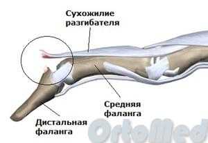 разрыв разгибателя