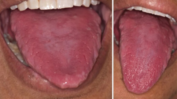 Пернициозная анемия