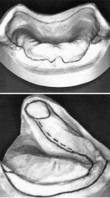 Границы базиса на верхней и нижней челюсти