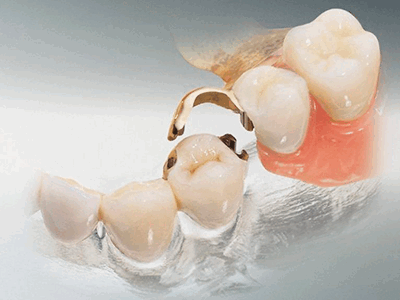 элементы бюгельного протеза фото