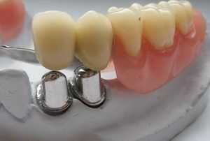 Протезирование опорных зубов