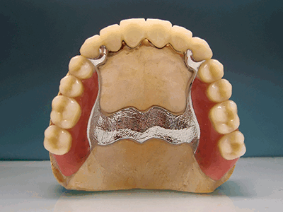 как выглядит бюгельный протез фото