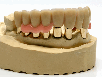 части бюгельного протеза фото
