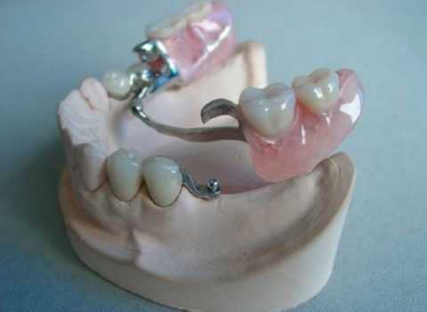 Путь введения протеза