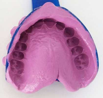 Альгинантный оттиск, по которому техник отливает диагностическую модель