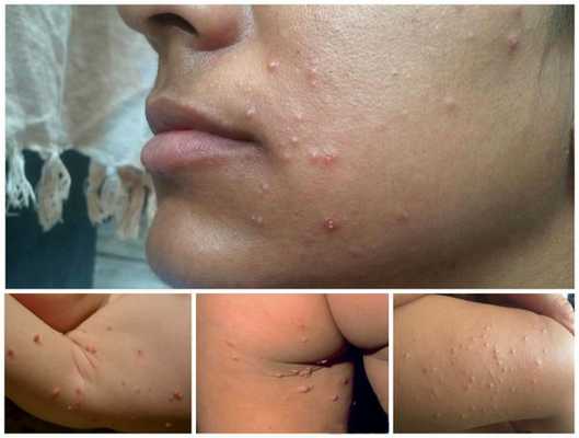 Контагиозный моллюск на различных участках тела