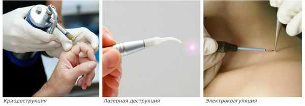 Методы лечения контагиозного моллюска