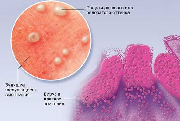 Контагиозный моллюск в клетках эпителия