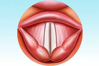 Спастическая дисфония