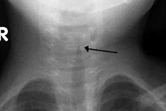 Травматические повреждения