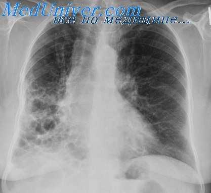 кавернотомия