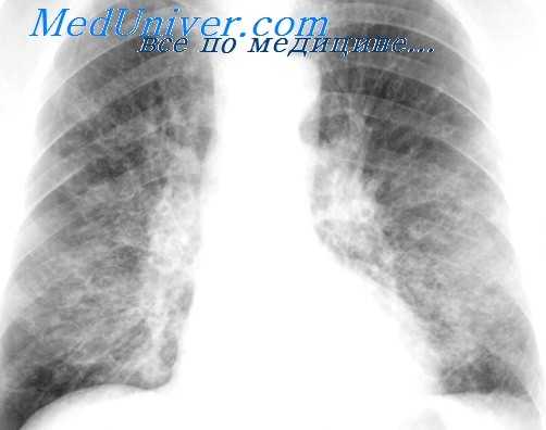 кавернотомия