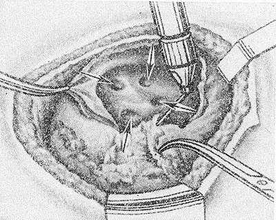 Рис. 2. Схематическое изображение операции иссечения наружной стенки большой каверны: устья дренирующих бронхов, открывающиеся в каверну, указаны стрелками.