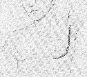 Рис. 1. Схематическое изображение линии разреза при операции по поводу каверны верхней доли левого легкого.