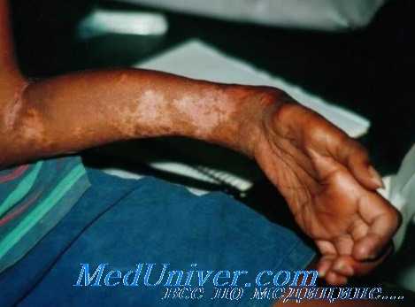 контрактура Фолькмана