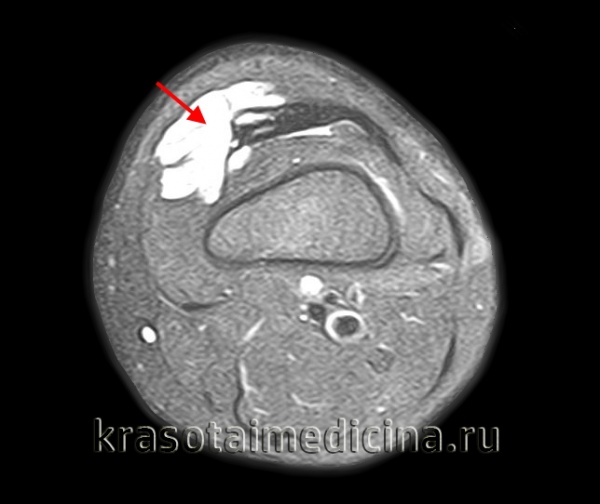 Ишемическая контрактура Фолькмана