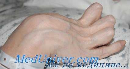 Ишемическая контрактура Фолькмана