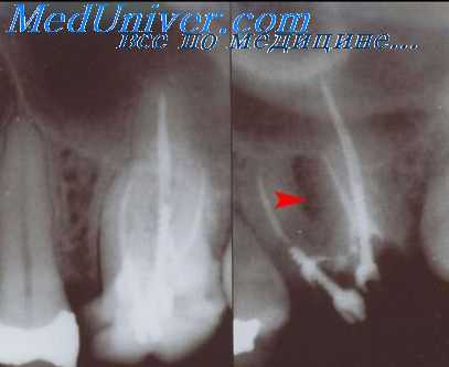 контрактуры нижней челюсти