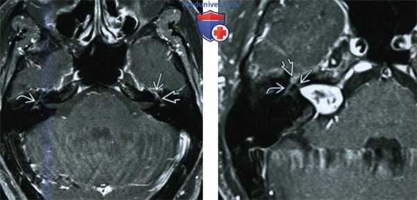 Контрастирование внутривисочного сегмента лицевого нерва - лучевая диагностика