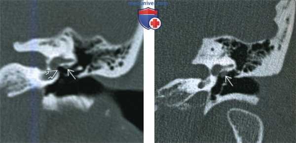 Пролабирование лицевого нерва в среднее ухо - лучевая диагностика