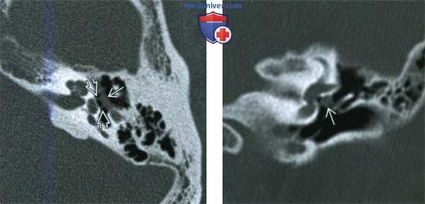 Пролабирование лицевого нерва в среднее ухо - лучевая диагностика