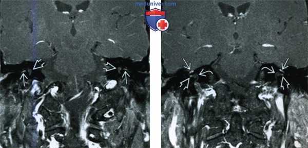 Контрастирование внутривисочного сегмента лицевого нерва - лучевая диагностика