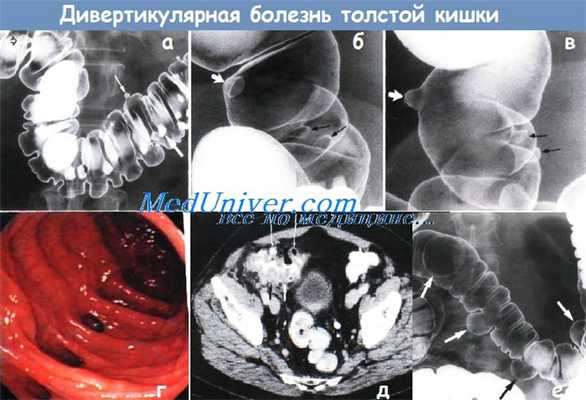 Дивертикулярная болезнь толстой кишки