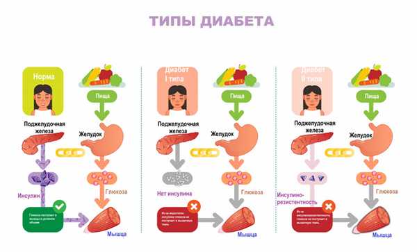 Типы сахарнеого диабета.jpg