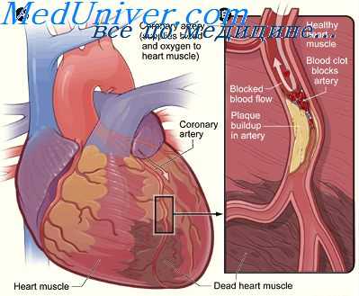 сердце при алкоголизме