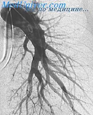 ангиопульмонография