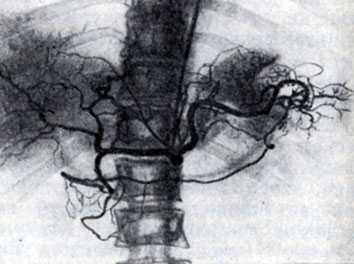 Рис. 4. Зондирование и селективная ангиография чревного ствола. Контрастированы внутрипеченочные артерии, артерии, огибающие кисту, внутриселезеночная и желудочно-двенадцатиперстно-кишечная артерии (справа вдоль позвоночника виден катетер)