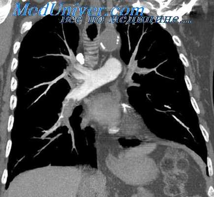 ангиопульмонография