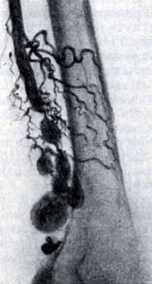Рис. 1. Ангиограмма бедра. В нижней трети определяются артерио - венозные аневризмы