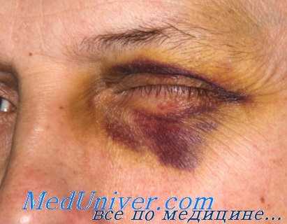 контузии век