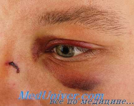 контузия роговицы