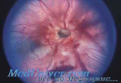 контузия зрительного нерва